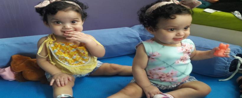 Cirurgia rara de separação de irmãs siamesas no Hospital Estadual da Criança completa um ano