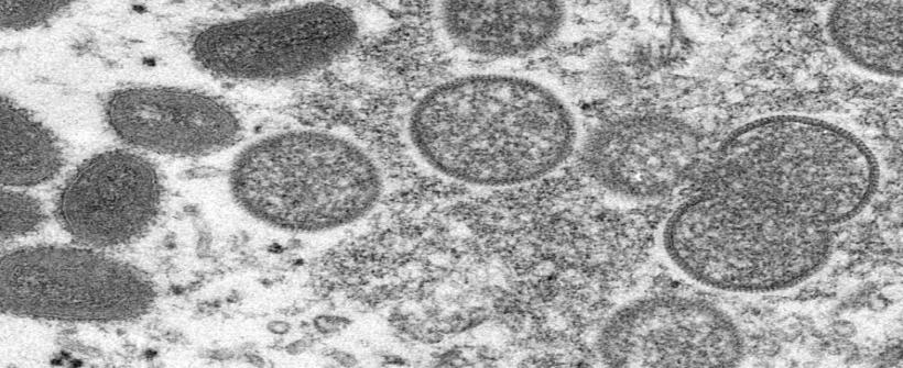 Rio de Janeiro registra primeiro óbito por Monkeypox