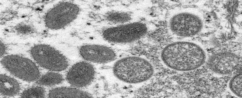 Rio de Janeiro registra segundo óbito por Monkeypox